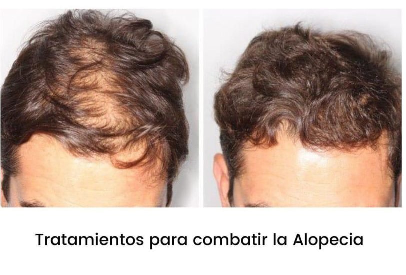 Hair Treatments