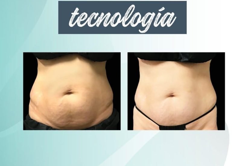Body Contouring
