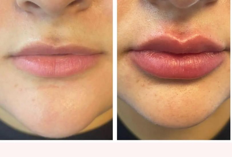 Lips Treatments