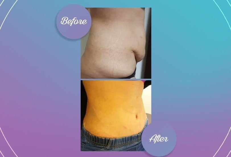 Fat Transfer