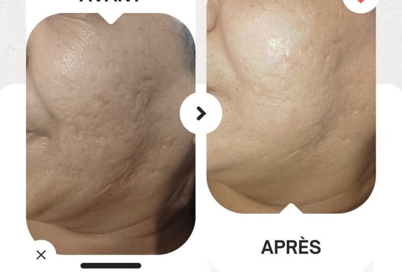 Acne & Scar Treatments