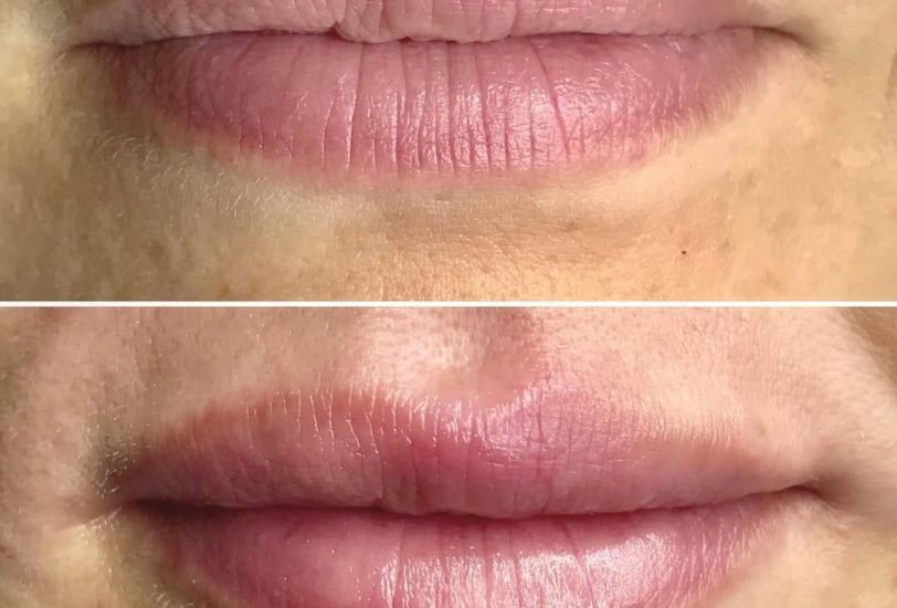Lips Treatments