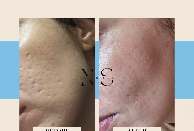 Acne & Scar Treatments