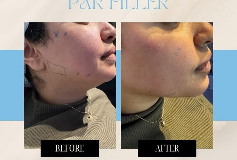 Facial Contouring & Lifting