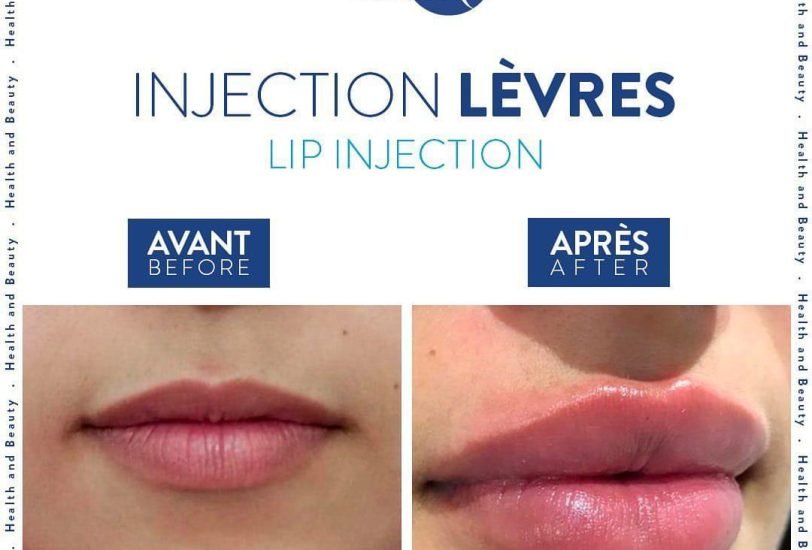 Lips Treatments