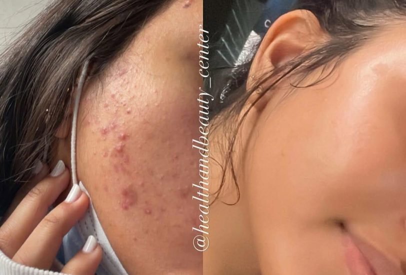 Acne & Scar Treatments