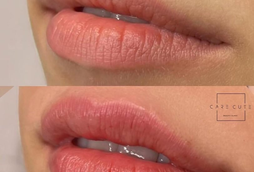 Lips Treatments