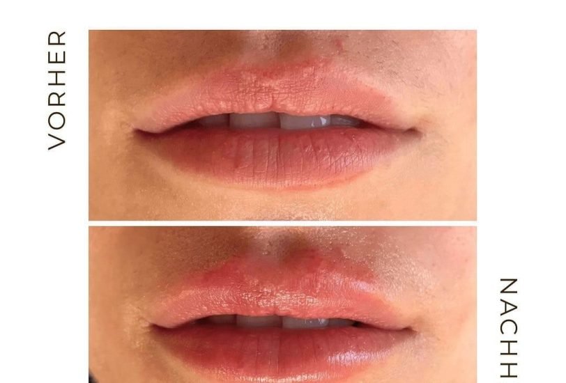 Liposuction