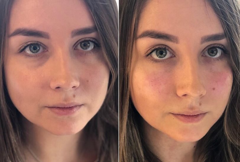 Skin Tightening