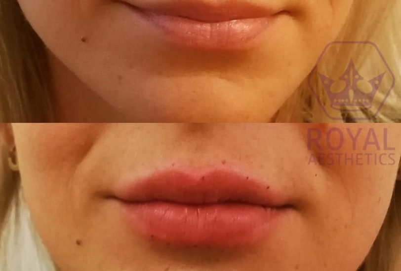 Lips Treatments
