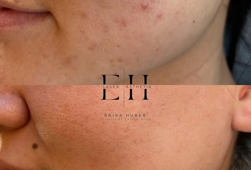 Acne & Scar Treatments