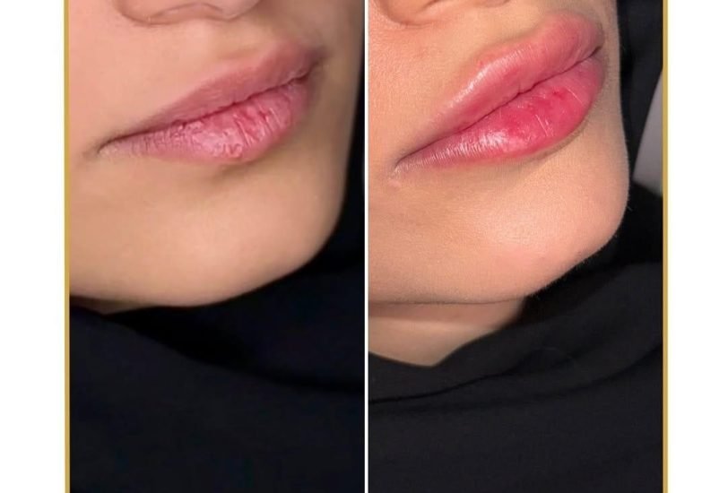Lips Treatments