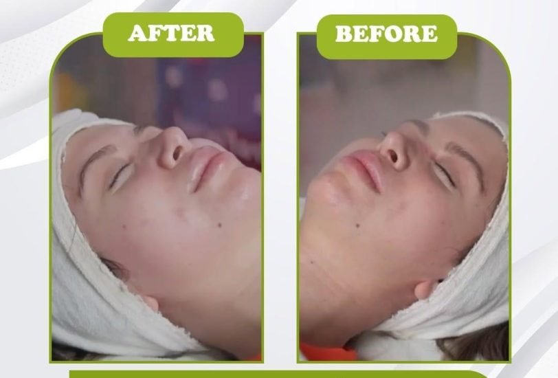 Pigmentation & Skin Tone Correction