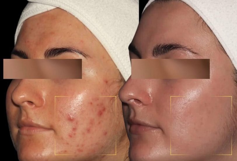 Acne & Scar Treatments