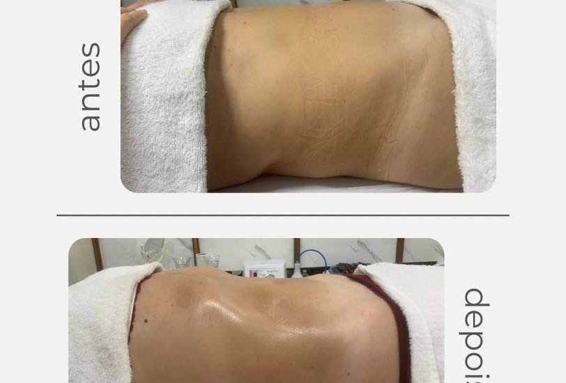 Body Contouring