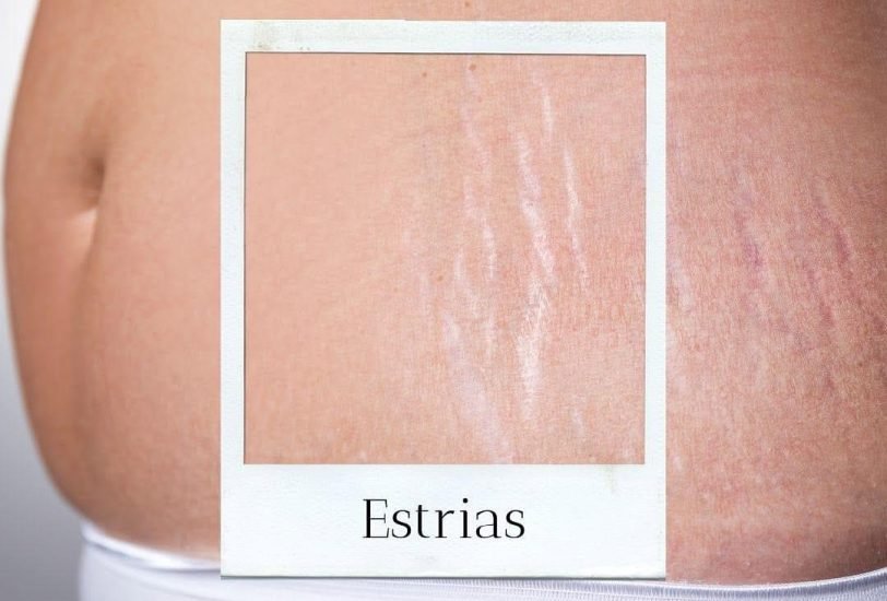 Stretch Mark Treatment