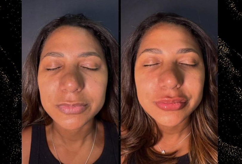 Lips Treatments