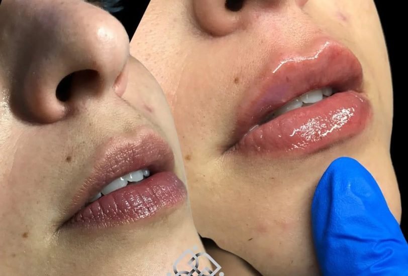 Lips Treatments