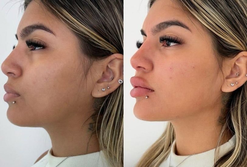 Lips Treatments