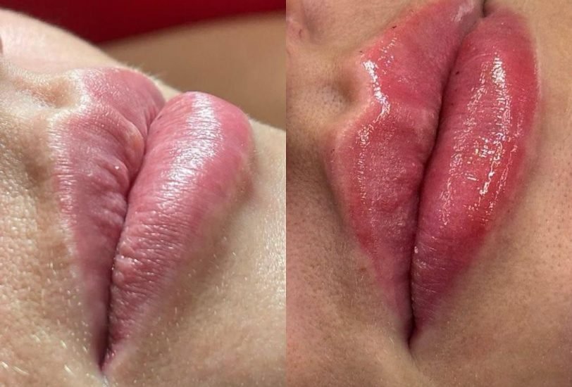 Injectable Treatments