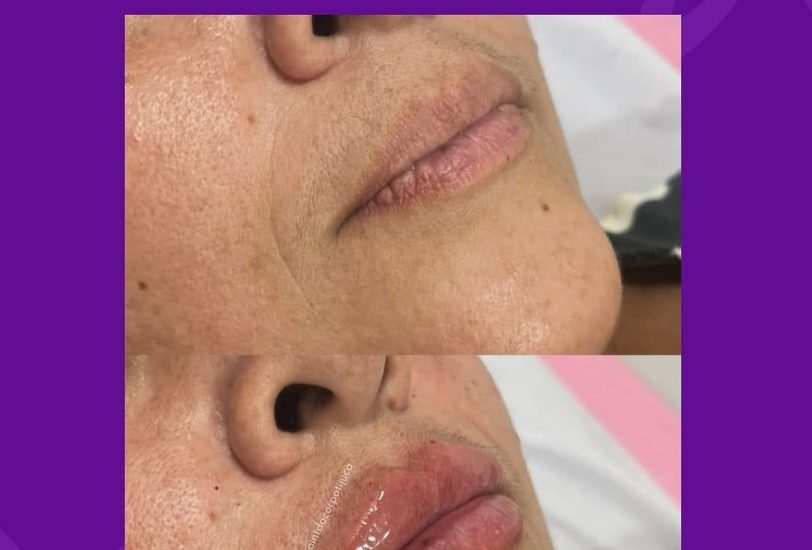 Lips Treatments