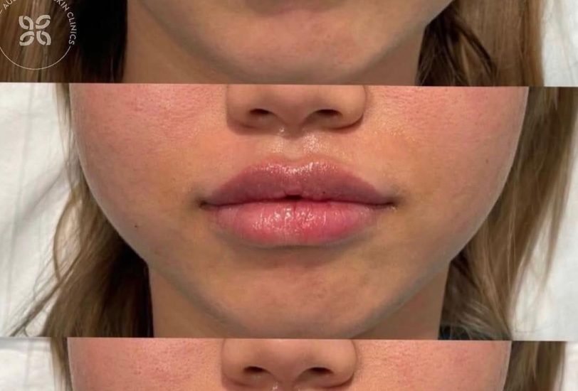 Lips Treatments