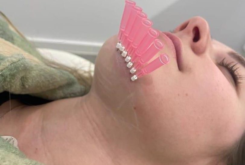 Double Chin & Jawline Contouring