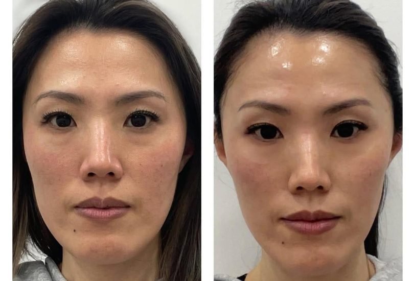 Facial Contouring & Lifting