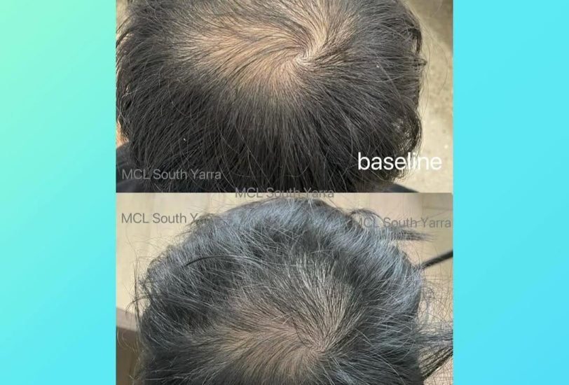 Hair Treatments