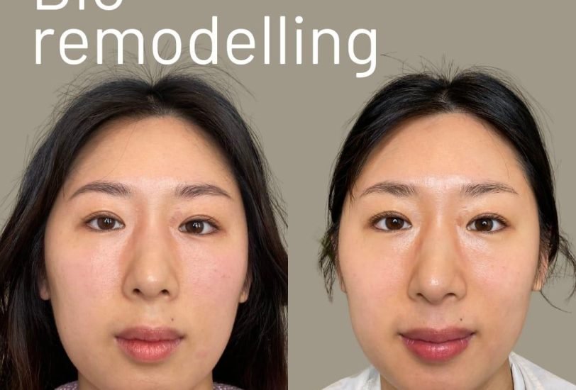 Facial Contouring & Lifting