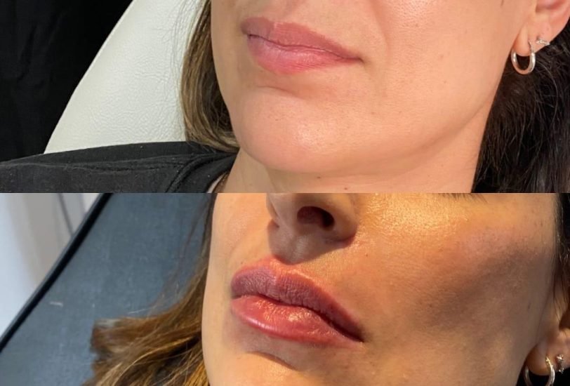 Double Chin & Jawline Contouring