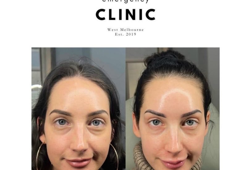 Facial Contouring & Lifting
