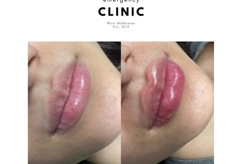 Lips Treatments