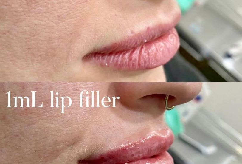 Lips Treatments