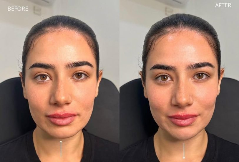 Facial Contouring & Lifting