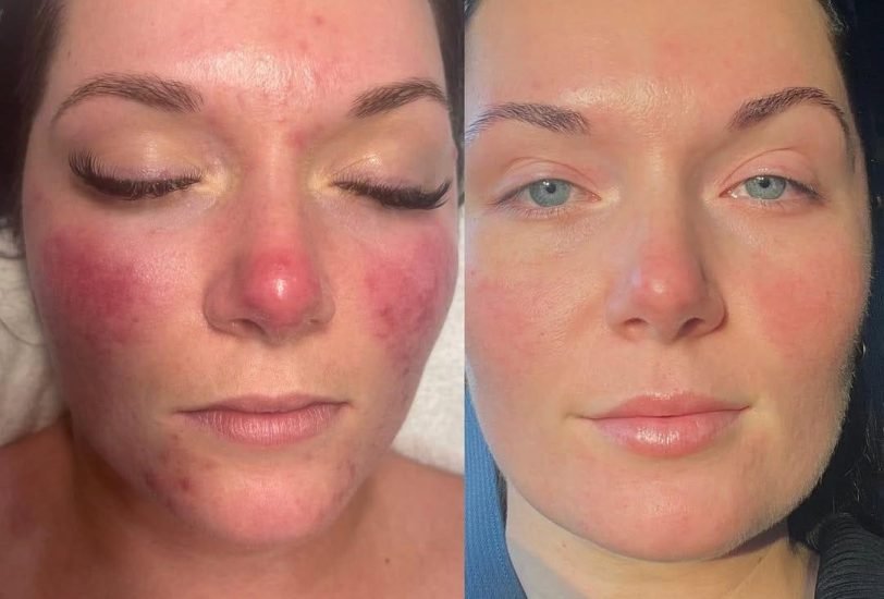 Acne & Scar Treatments