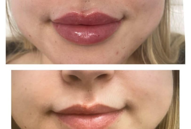 Lips Treatments