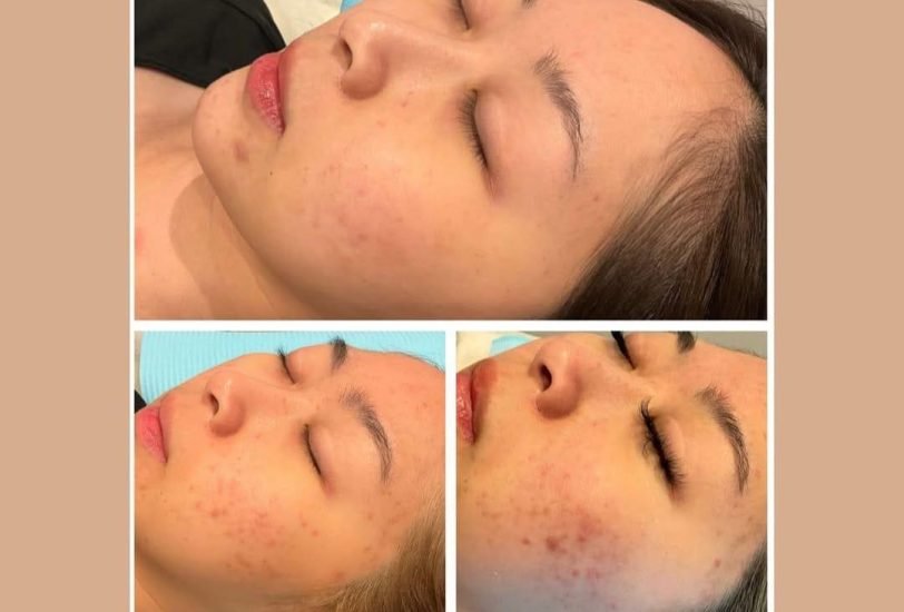 Acne & Scar Treatments