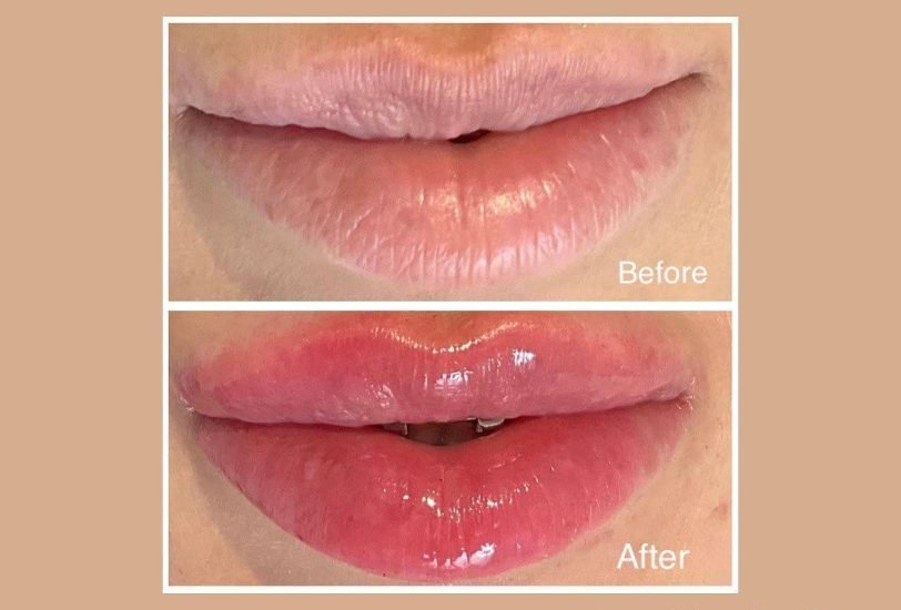 Lips Treatments