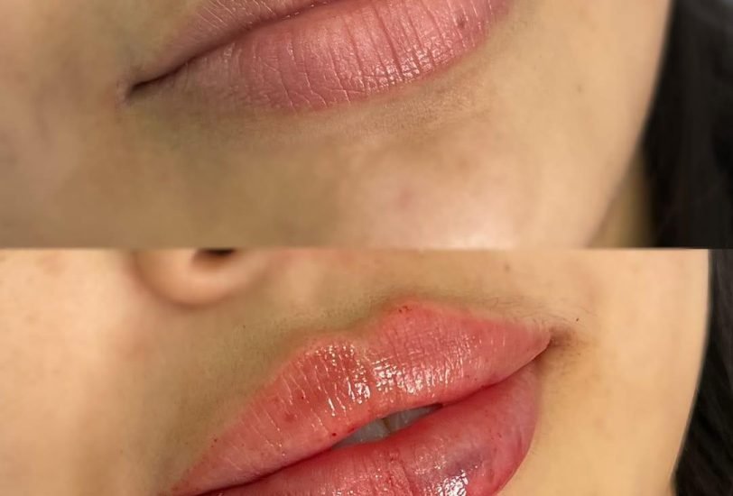 Lips Treatments