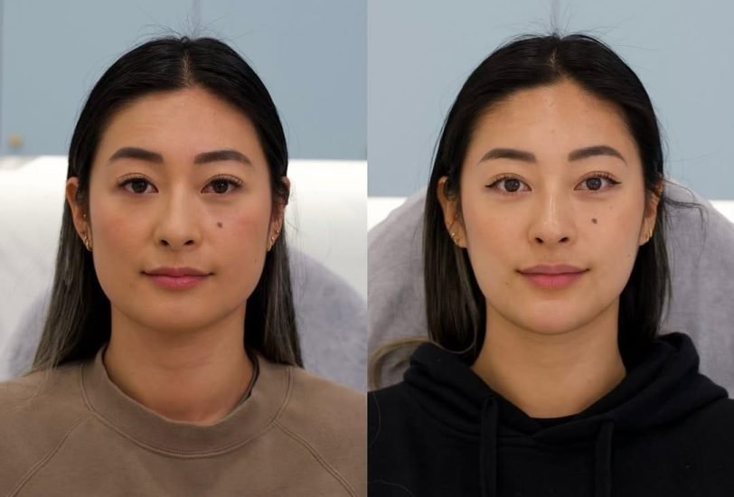 Skin Rejuvenation