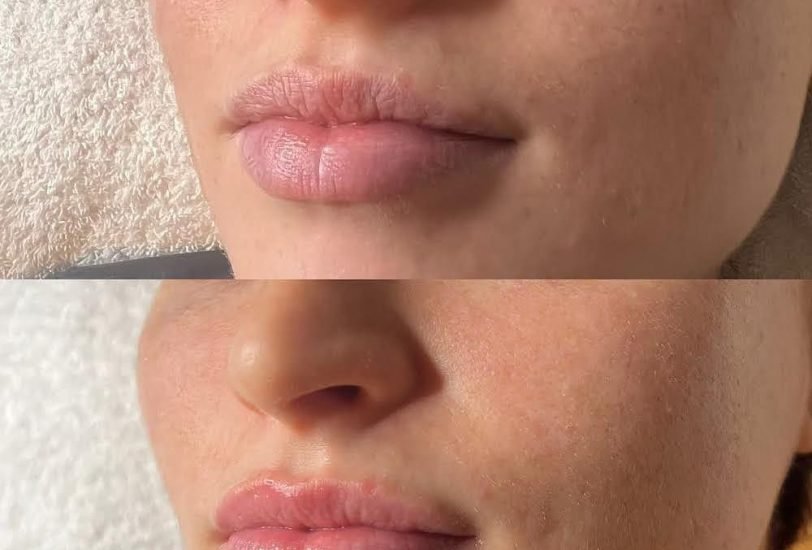 Skin Rejuvenation