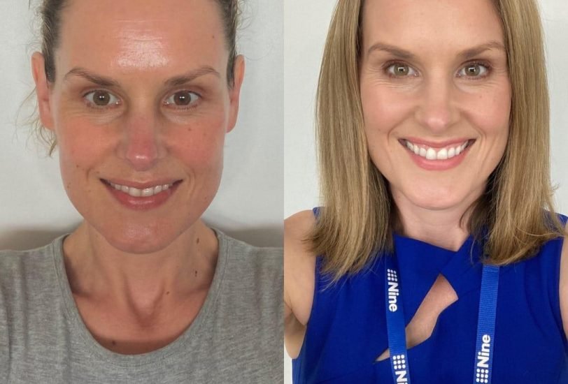 Skin Rejuvenation