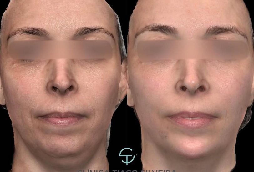 Double Chin & Jawline Contouring