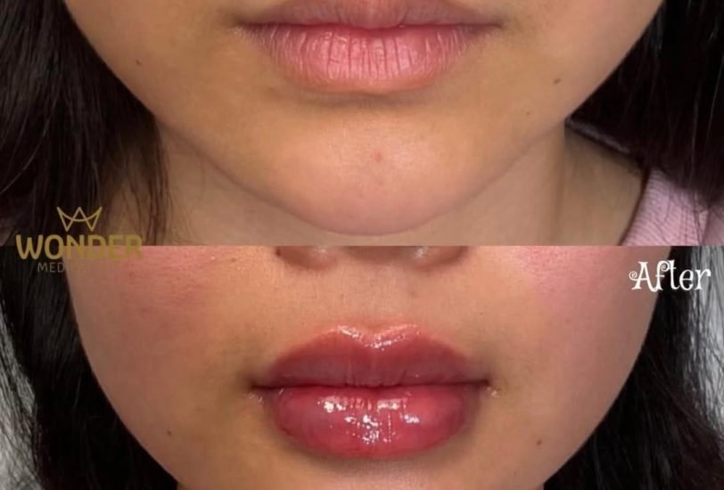 Lips Treatments