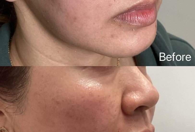 Facial Contouring & Lifting