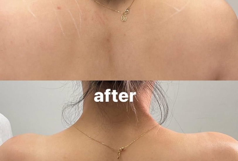 Body Contouring