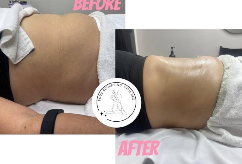 Body Contouring