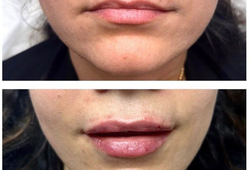 Lips Treatments