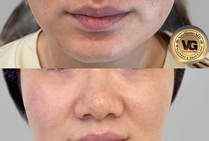 Acne & Scar Treatments
